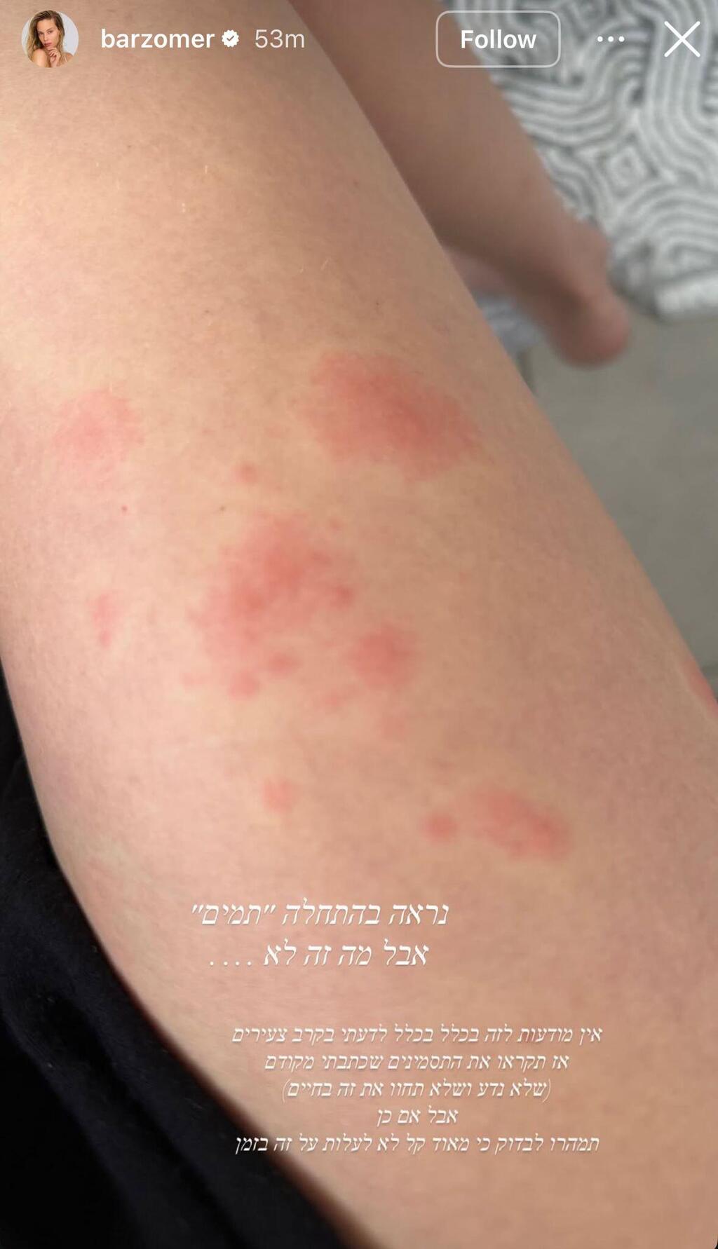 בר זומר משתפת שחלתה בשבקת חוגרת