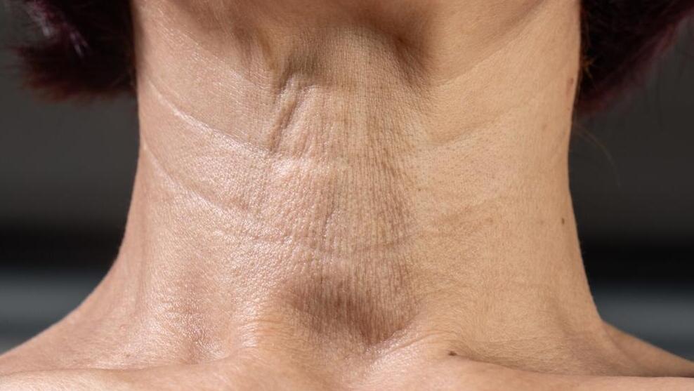 Loss of elasticity; neck wrinkles (Photo: Shutterstock) קמטי צוואר