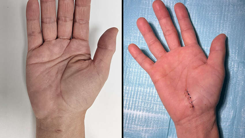 After CTS surgery - scar comparison ניתוח תסמונת התעלה הקרפלית - השוואת צלקות