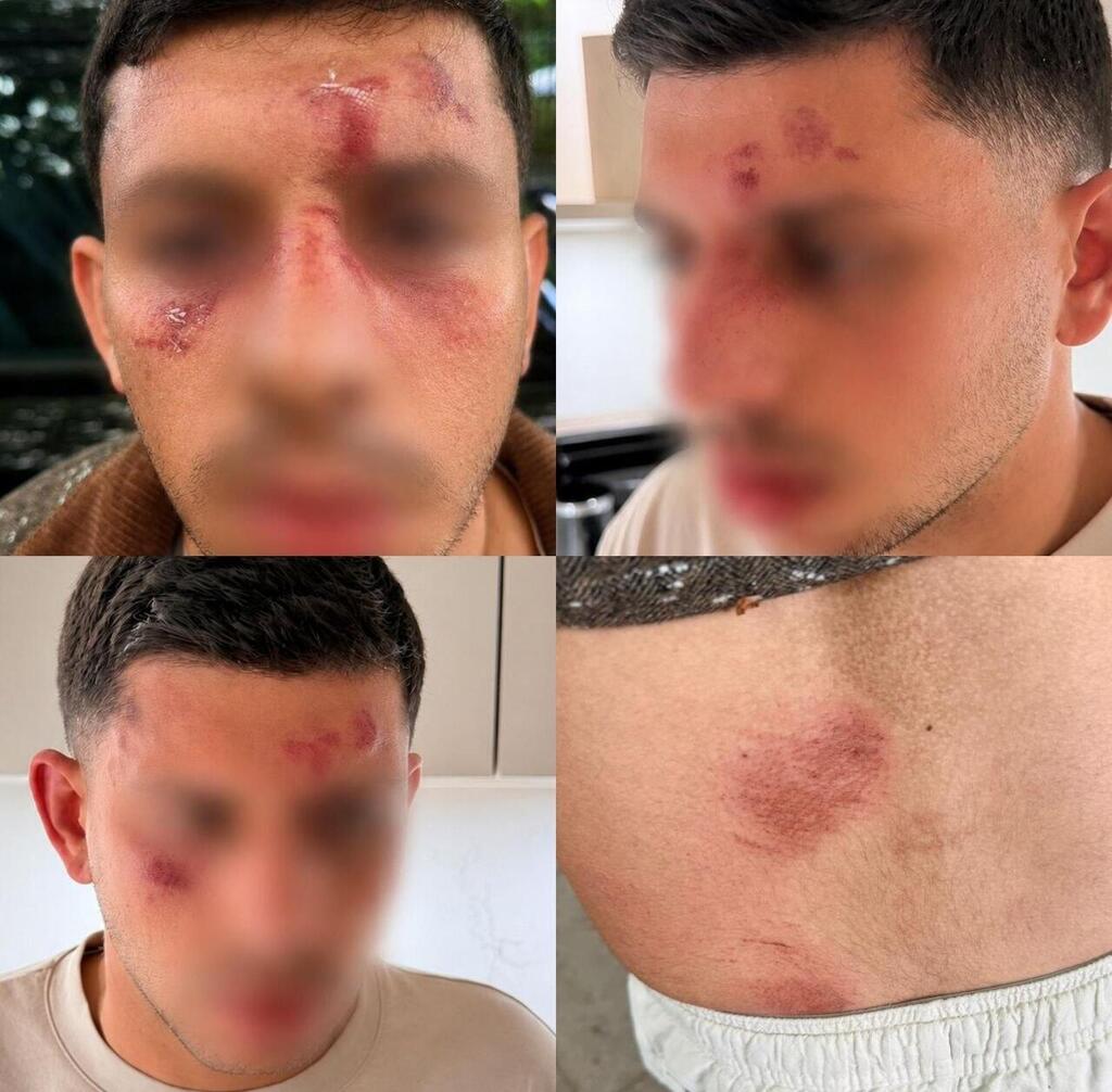 Israeli man attacked in London צעיר יהודי הותקף בלונדון