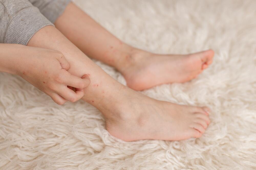 Itching after a mosquito bite is caused by the immune system’s reaction to proteins in mosquito saliva (Photo: Shutterstock) יתושים, עקיצות יתוש