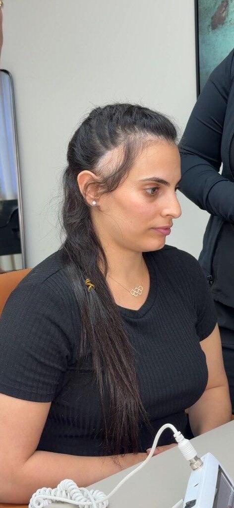 "לא מתביישת בקרחות". לינוי אשרם בהשתלת השיער (צילום: אור גפן ) לינוי אשרם השתלת שיער