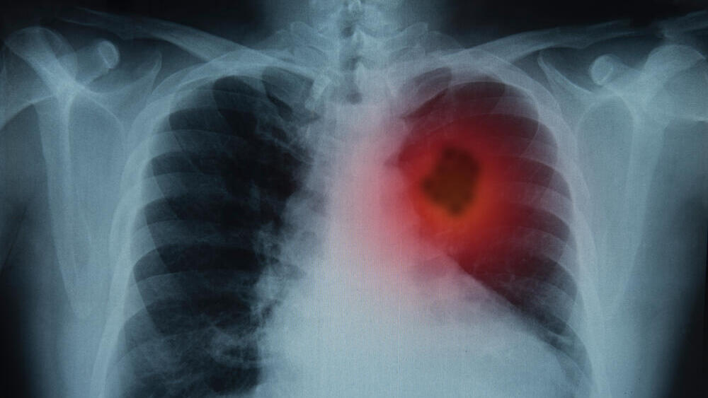 Researchers found a link between e-cigarette use after quitting smoking and a higher risk of lung cancer (Photo: Shutterstock) סרטן ריאות