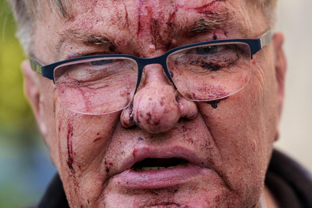 He was injured in the Russian attack on Ukraine (Photo: Evgeniy Maloletka/AP) מתקפה של רוסיה על קייב אוקראינה