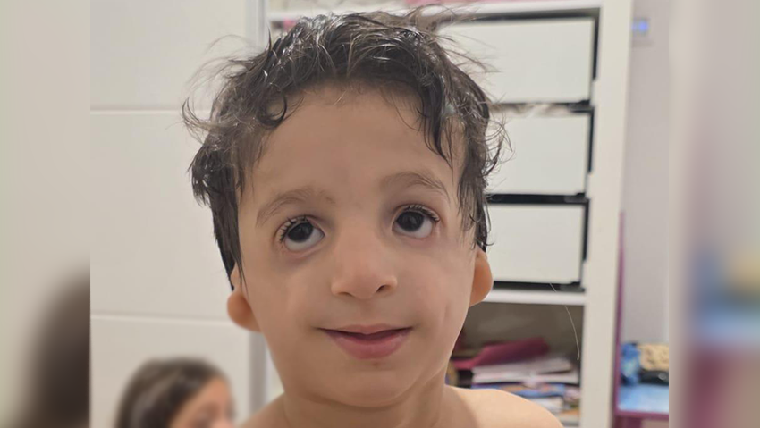 אדיר בר נולד עם תסמונת טריצ'ר קולינס