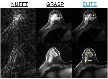 ELITE results in two patient: provides high temporal and spatial resolution, reduces noise, and enhances the visualization of breast tumor (marked in yellow) and blood vessels morphology (Photo: Technion) Demonstration of ELITE results in two patients