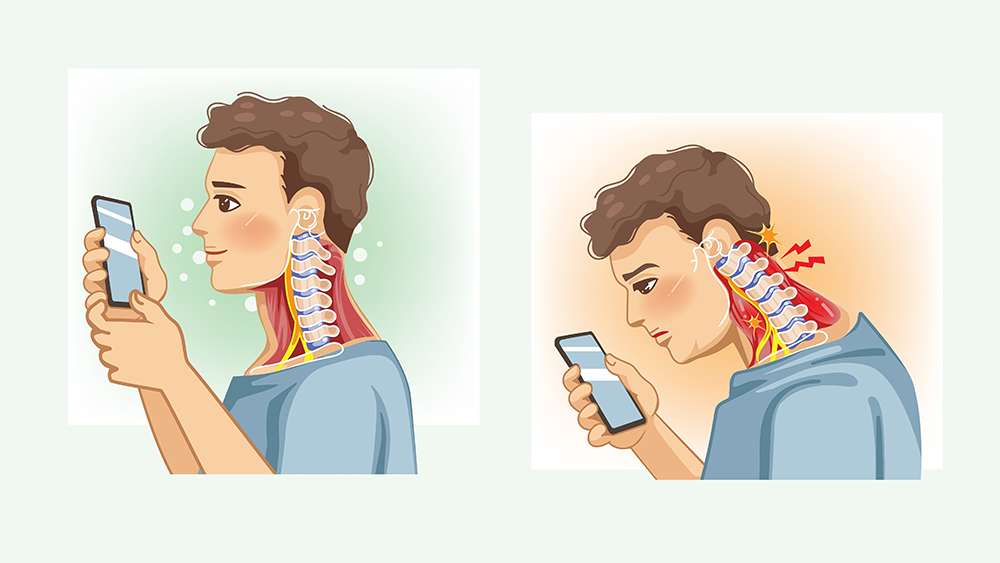 Bending the head while using a phone significantly increases the strain on the spine (Photo: Shutterstock) טלפון