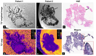  The research is aimed at improving early detection of ovarian cancer, particularly among women with inherited BRCA gene mutations