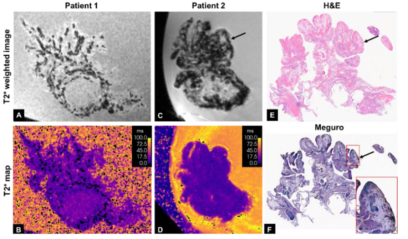 The research is aimed at improving early detection of ovarian cancer, particularly among women with inherited BRCA gene mutations (Photo: Courtesy of Technion) The research is aimed at improving early detection of ovarian cancer, particularly among women with inherited BRCA gene mutations