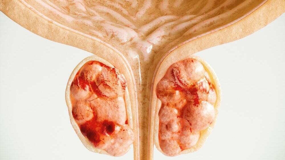 Prostate cancer imaging (Photo: Shutterstock) הדמיה של סרטן הערמונית