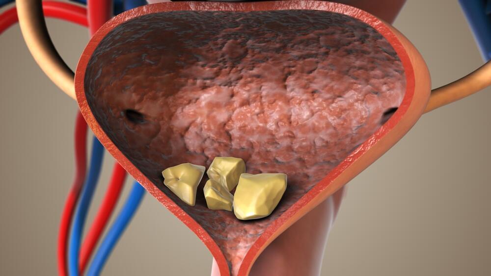 Kidney stones (Illustration: Shutterstock) אבנים בכליות