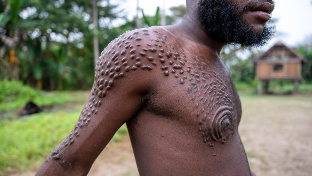 Marks from the skin carvings of the coming-of-age ceremony (Photo: Hadar Epstein) צלקות בצורת עור תנין