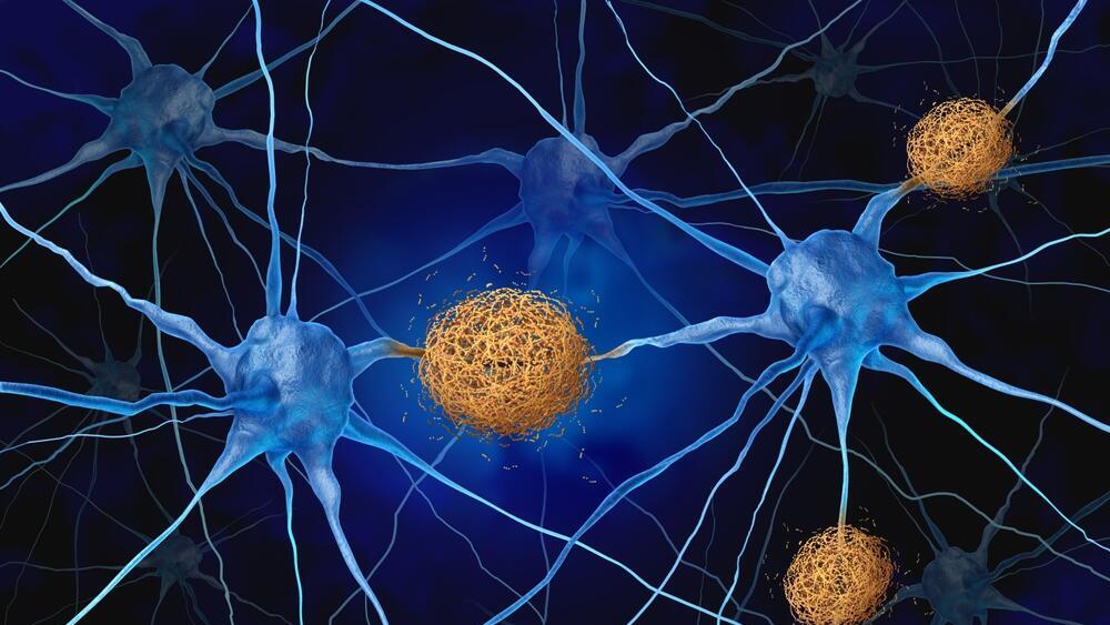 Amyloid-beta accumulation in the brain of a person with Alzheimer's disease (Photo: Shutterstock) הצטברות עמילואיד בטא במוח של חולי אלצהיימר