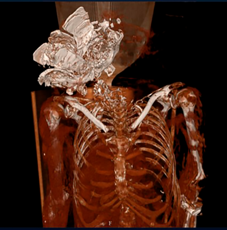 Terrorists ran over a person’s head — as seen on a CT scan (Photo: National Center of Forensic Medicine) עדויות 7 באוקטובר: המחבלים דרסו ראש של אדם - כך זה נראה בצילום CT