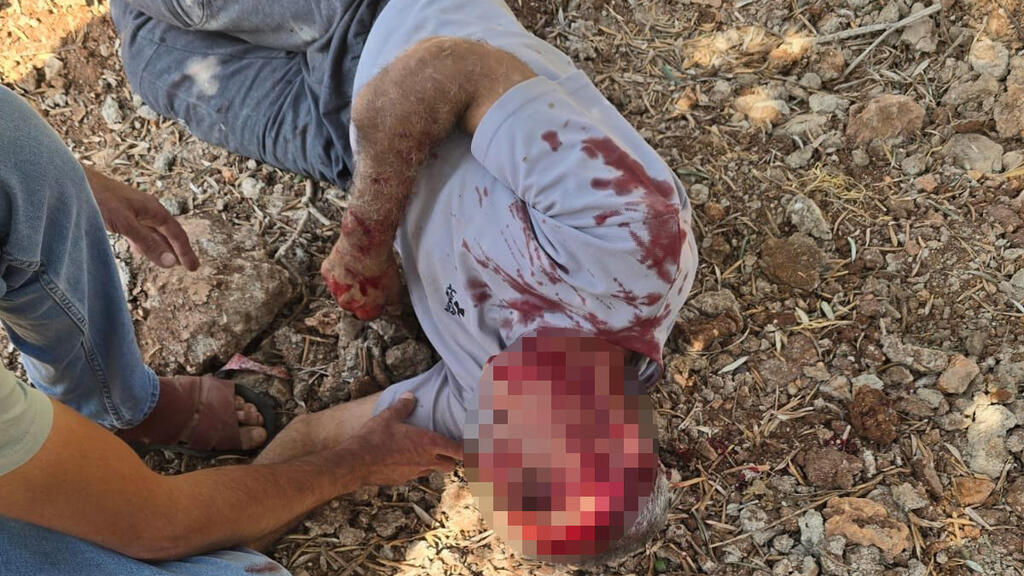 A Palestinian was injured after being violently attacked by settlers in the village of Usran, south of Nablus פלסטיני נפצע לאחר שהותקף באלימות קשה על-ידי מתנחלים בכפר אוסרן, דרומית לשכם.