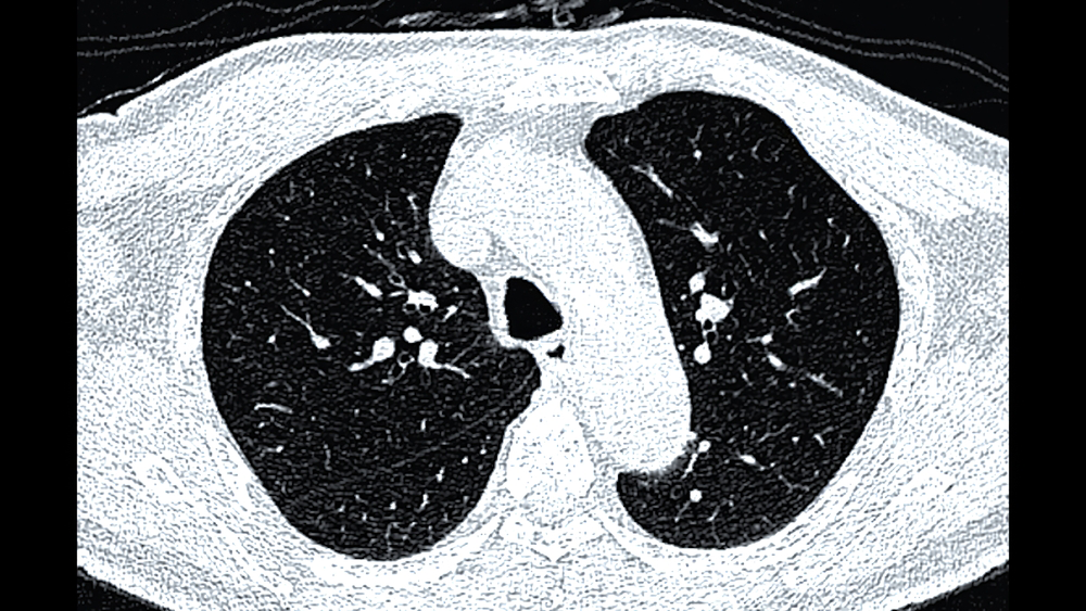CT scan showing a lung nodule (Photo: shutterstock) CT של קשרית בריאה