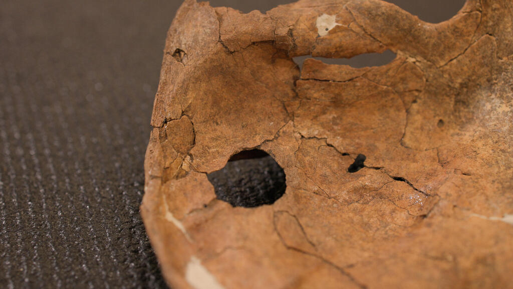 Closeup of the hole in the left shoulder blade (Photo: University of Cambridge) עצם השכם השמאלית של "שאנידאר A"