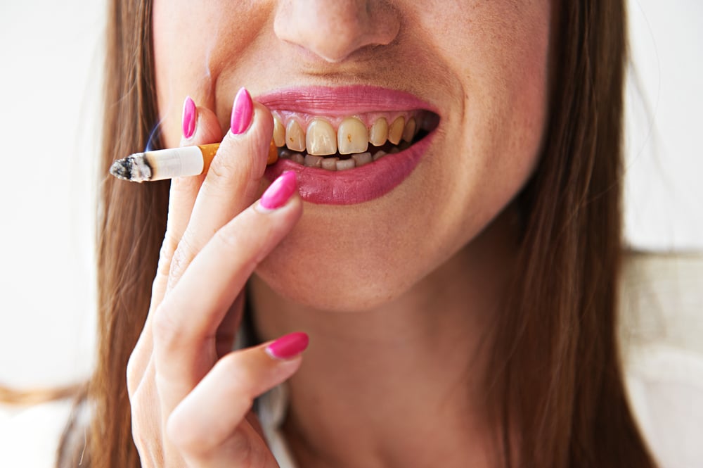 השפעת העישון על מצב החניכיים (צילום: shutterstock) השפעת העישון על מצב החניכיים