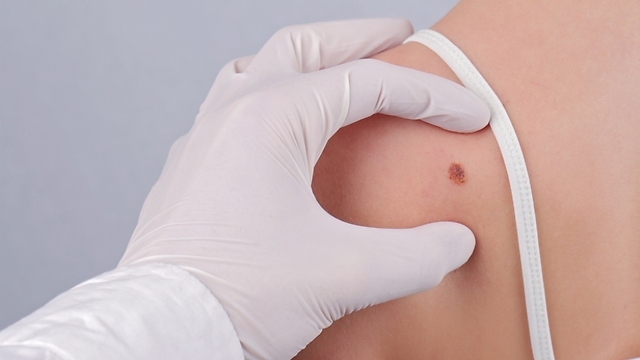 Detecting melanoma (Photo: Shutterstock) Detecting melanoma