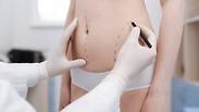 המסת שומן שאיבת שומן
