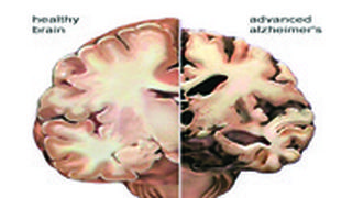 מימין לשמאל: מוח חולה בדמנציה לעומת מוח בריא
