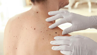 בדיקה מלנומה סרטן העור עור