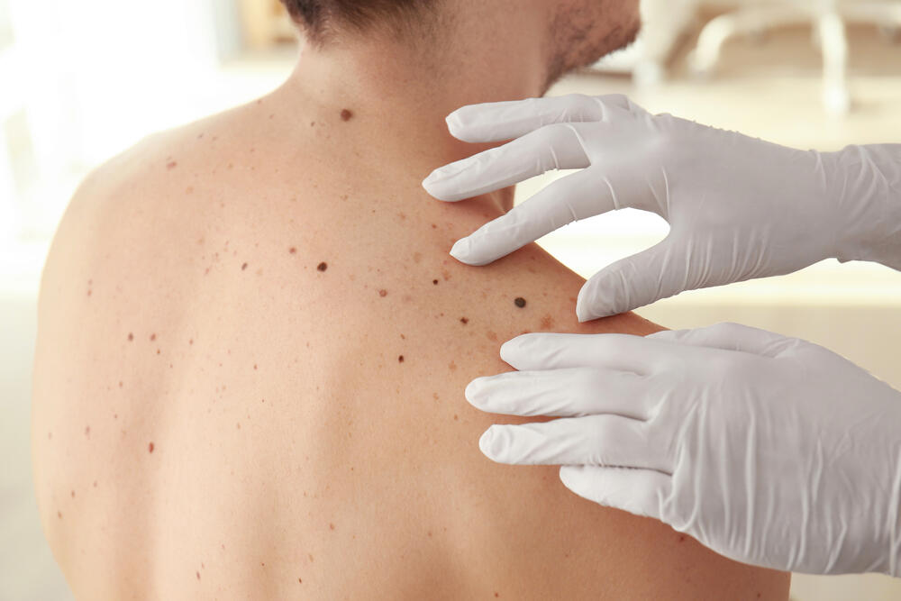 Testul cancerului de piele melanom