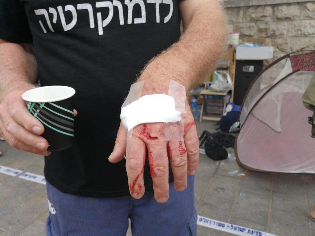 מפגין שנפצע בידו כוחות משטרה ופקחים הגיעו הבוקר למאהל המחאה בבלפור ופינו משם כ-30 מפגינים וציוד