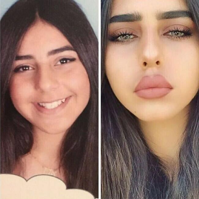 לפני ואחרי. אלין כהן נחשפת (צילום: אינסטגרם) לפני ואחרי. אלין כהן נחשפת