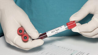 איידס HIV