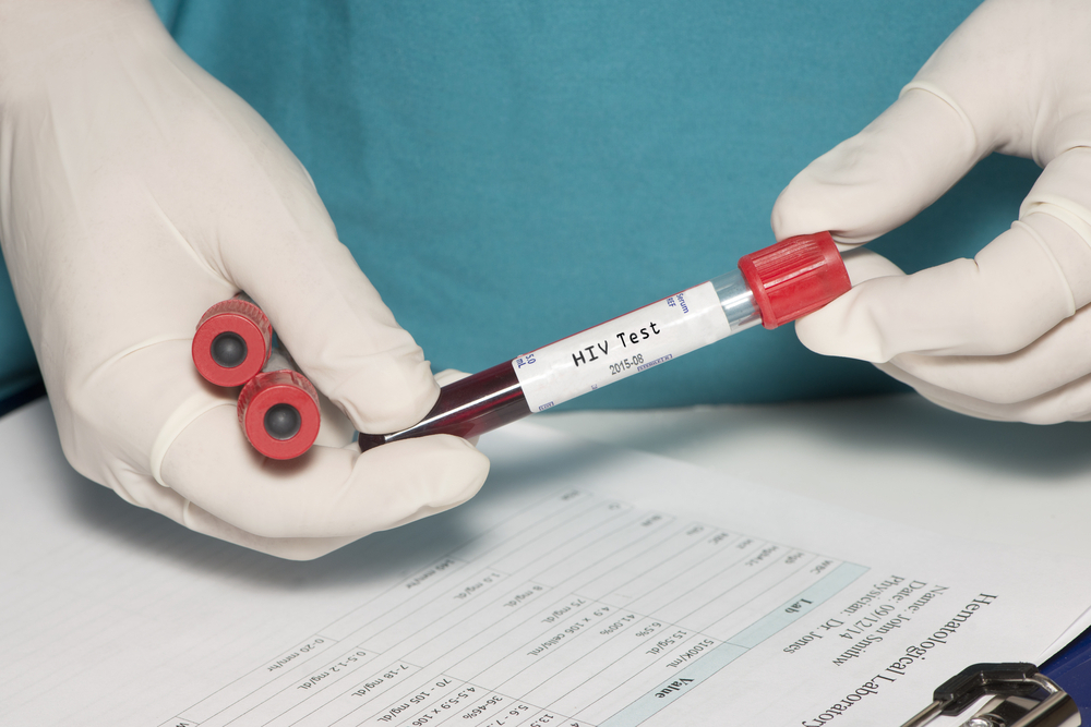 איו חיסון או ריפוי. בדיקת HIV (צילום: shutterstock) איידס HIV