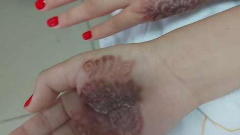 Девочка в Израиле сделала татуировку хной, и у нее чуть не отнялись руки