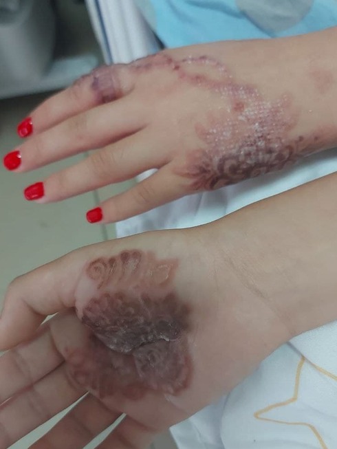 Девочка в Израиле сделала татуировку хной, и у нее чуть не отнялись руки