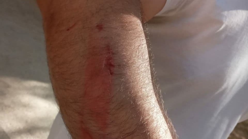 ברבי לאחר התקיפה הראשונה בחודש מאי אלירז ברבי לאחר התקיפה הראשונה בחודש מאי