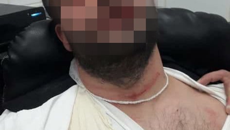 ברבי לאחר התקיפה הראשונה בחודש מאי אלירז ברבי לאחר התקיפה הראשונה בחודש מאי