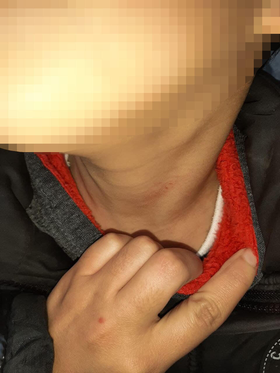 סימני אלימות על צווארו של אחד הילדים הילד עם סימני אלימות מהגן בירושלים