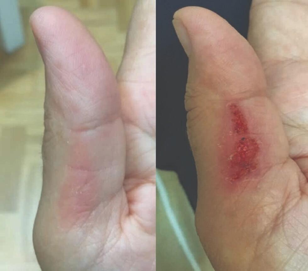 לפני טיפול בBioptron בכוויה באצבע ולאחר הטיפול