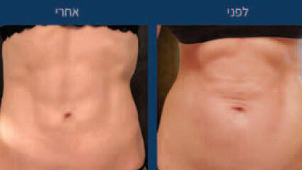 לפני ואחרי טיפול בבטן במכשיר Plasma-J (Renuvion, צילום וטיפול: Doolabh Vaishaili. d
