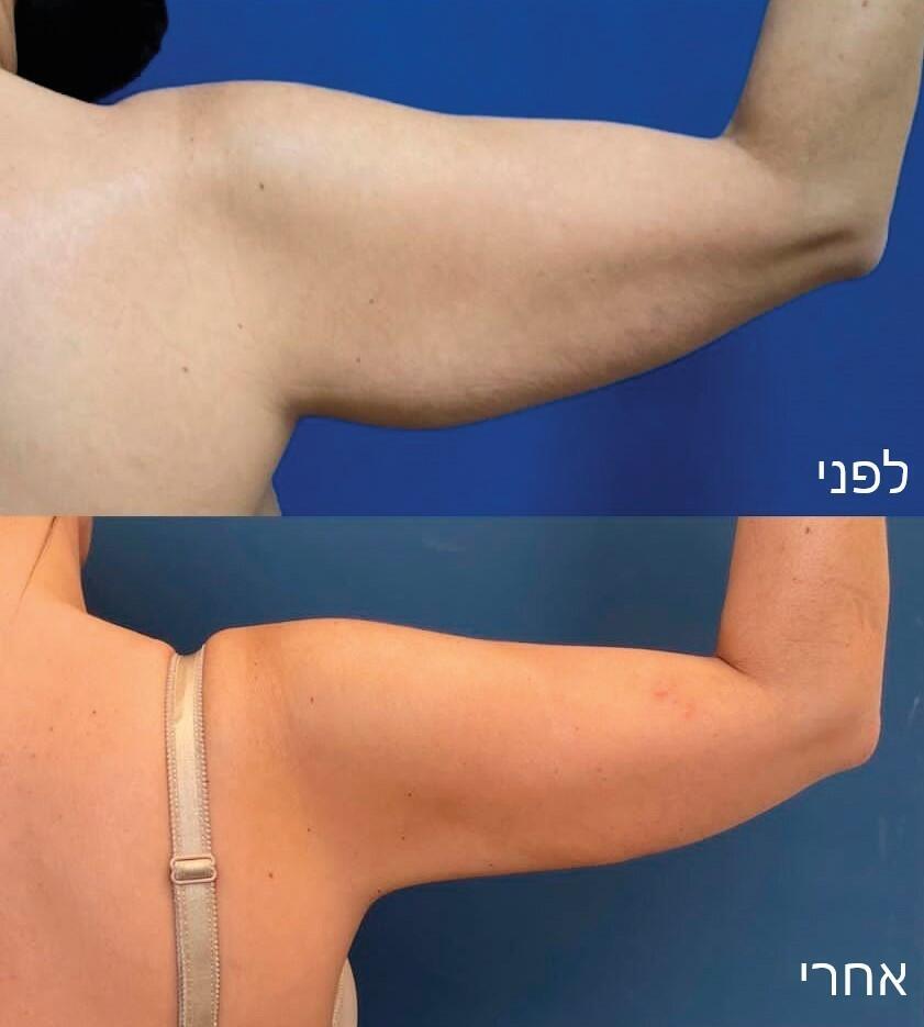 לפני ואחרי טיפול בזרועות (Plasma-J (Renuvion על ידי ד"ר ג'רמי נידם
