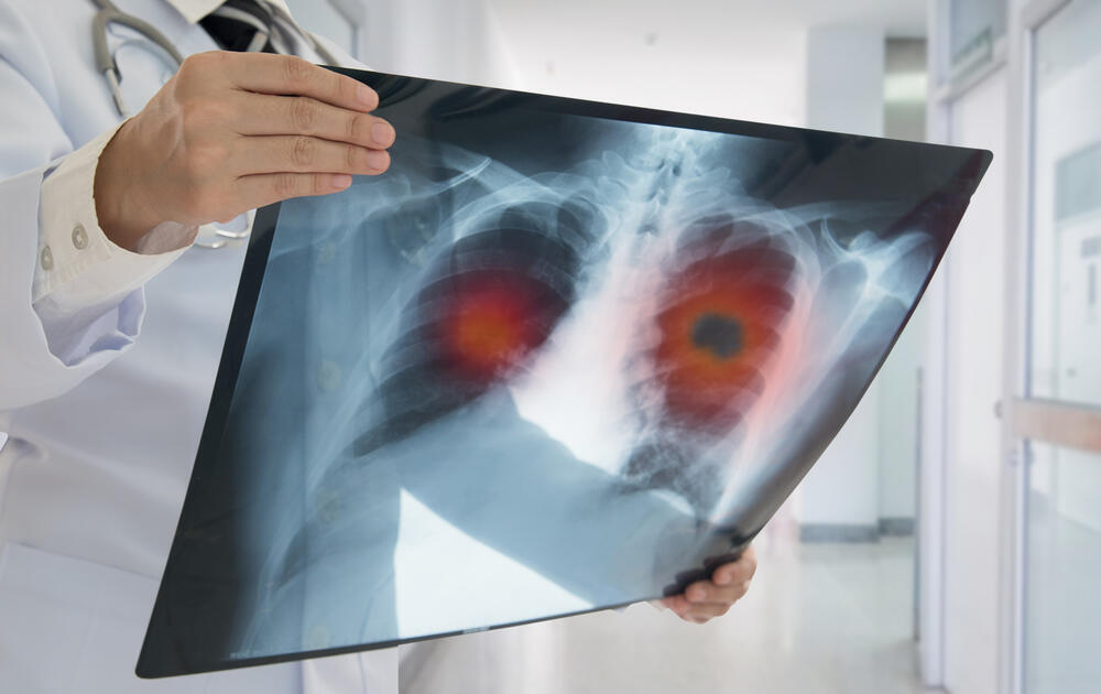 סרטן ריאות צילום רנטגן אבחון