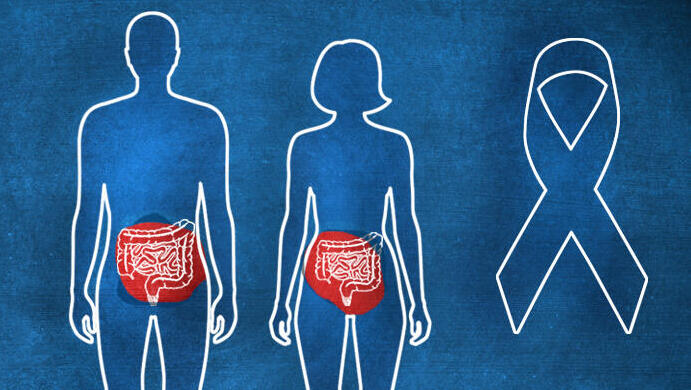 Все, что нужно знать в Израиле о раке толстой кишки