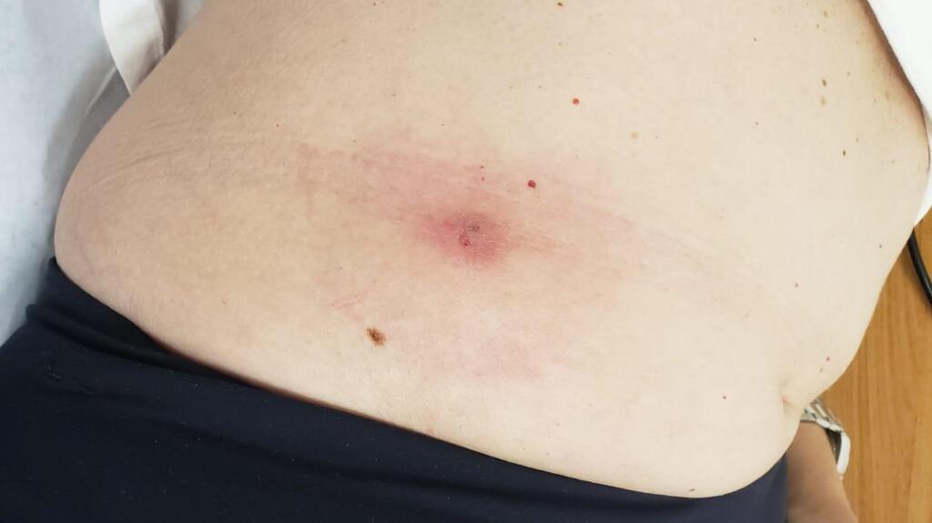 Israeli woman discovers tick under her skin upon returning from travels (Photo: Terem Emergency Medical Centers) רופאי טרם רפואה דחופה שלפו קרציה שחיה במשך שבועיים בתוך עורה של מטופלת