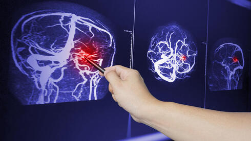 Know the signs: How to recognize a stroke before it's too late - Vimarsana News