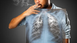 ריאות לאחר עישון