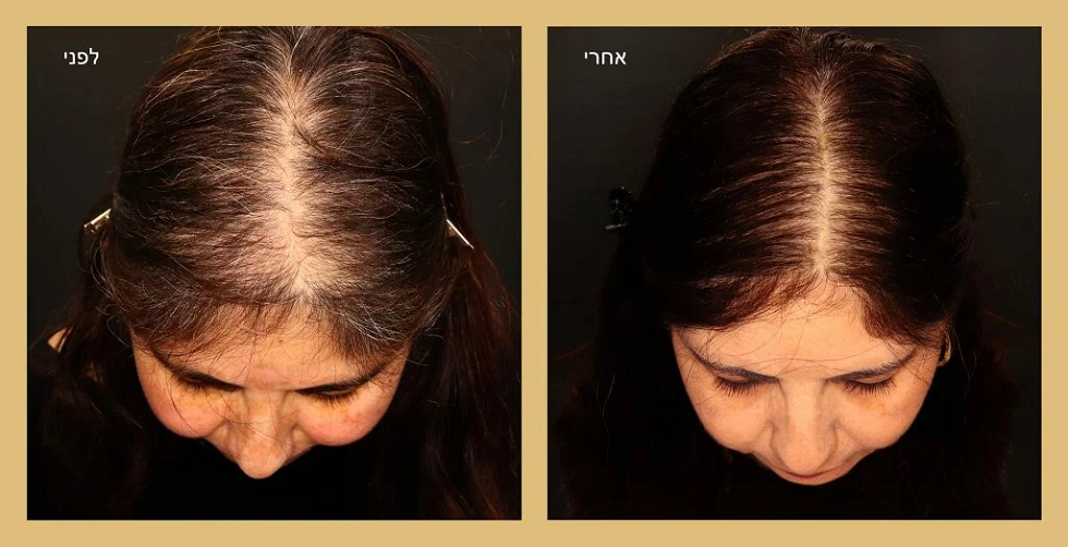 אבחון וטיפול בנשירה ודלילות שיער