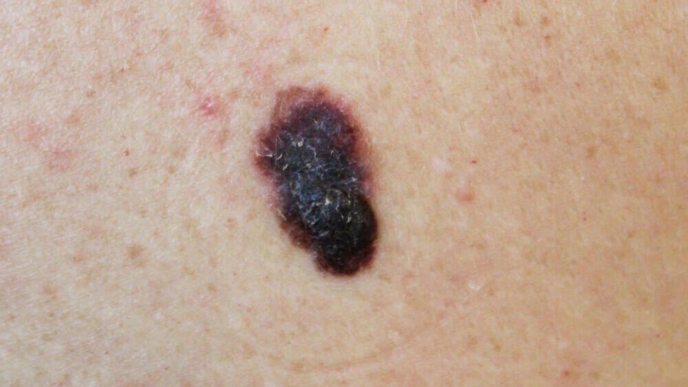 סרטן העור מלנומה