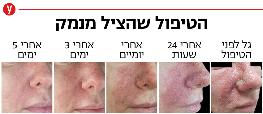 הזרקת חומצה היאלורונית שהסתבכה הזרקת חומצה היאלורונית שהסתבכה