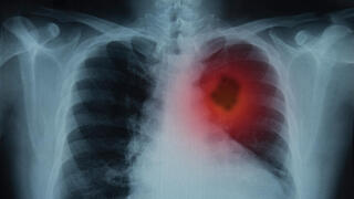 סרטן הריאות