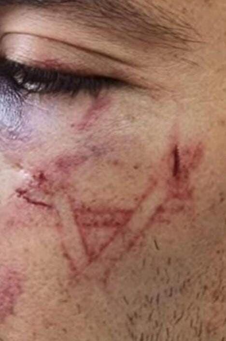 Wound on the suspect's face (Photo: Israel Police) מעצר אלים של סוחר סמים במחנה הפליטים שועפט