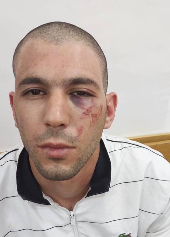 Arwaa Sheikh Ali following his arrest תושב מזרח ירושלים החשוד בעבירות סחר בסמים פצוע במעצרו